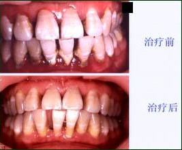 牙龈萎缩我们该怎么办呢