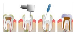 北京牙髓病该怎么治疗